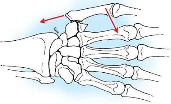 перелом-беннетта-рисунок