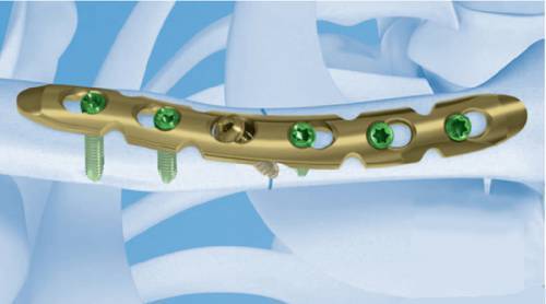 пластина-на-ключице