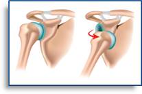 privyichnyiy-vyivih-plecha3