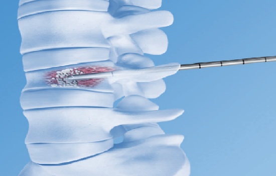 вертебропластика-позвонка