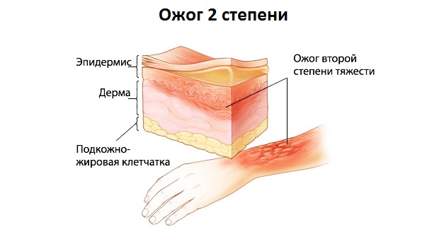 Ожог второй степени